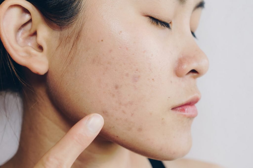 How To Get Rid Of Acne Scars