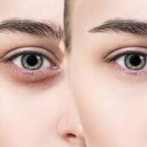 Dark Circles No More! Simple Hacks for Radiant Under-Eyes