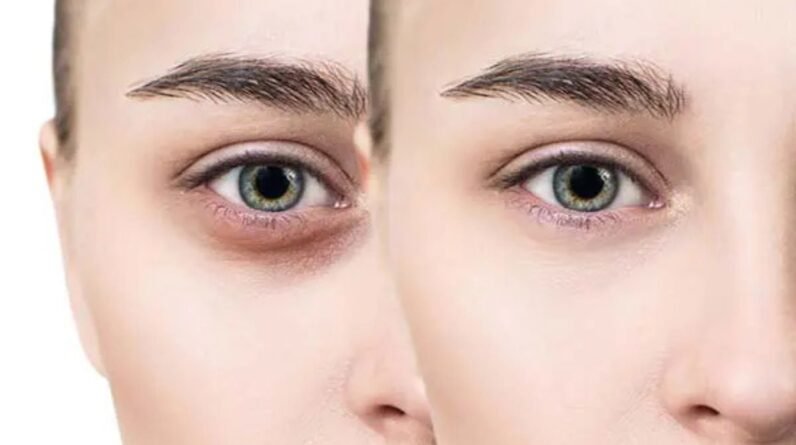 Dark Circles No More! Simple Hacks for Radiant Under-Eyes