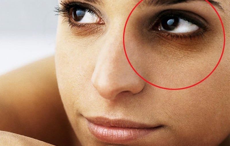 Dark Circles No More! Simple Hacks for Radiant Under-Eyes