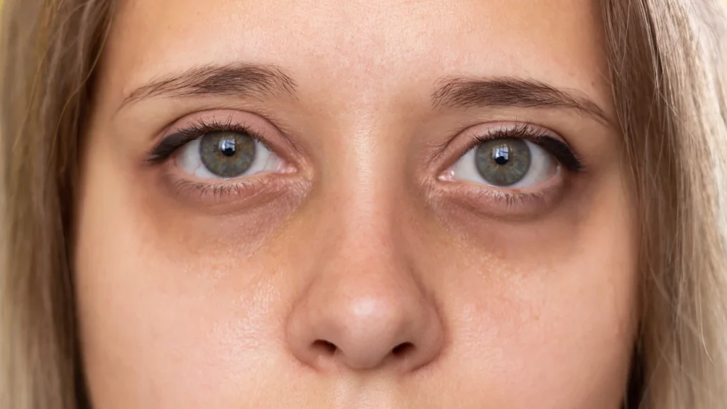 Dark Circles No More! Simple Hacks for Radiant Under-Eyes